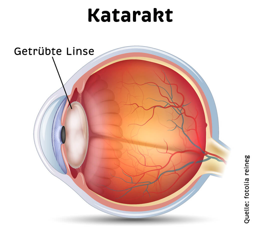 Schematische Darstellung eines Auges mit Katarakt